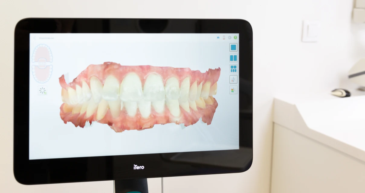 Scanner intra oral 3D Itero