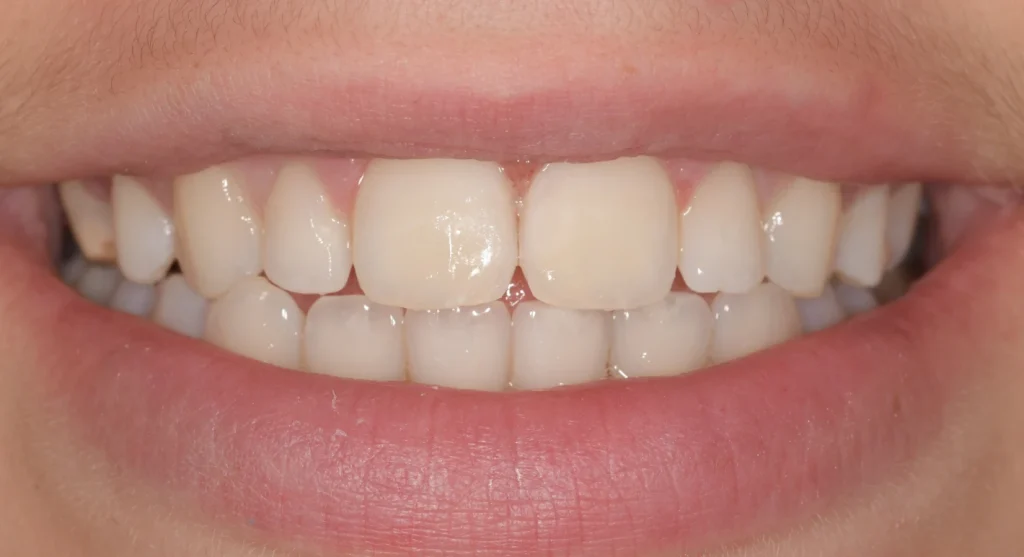 icon blanchiment dentaire dr hidalgo apres Traitement des tâches blanches : ICON